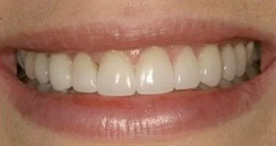 Patient after undergoing crown lengthening dental laser treatment in Mechanicsville, MD.