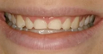 Patient before undergoing crown lengthening dental laser treatment.