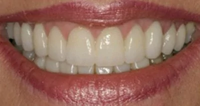 Patient from Waldorf after receiving porcelain crowns.