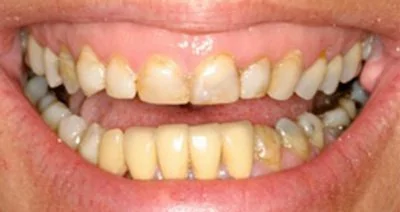 Patient from Waldorf before receiving a CEREC tooth crown.