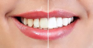 Professional Teeth Whitening Mechanicsville MD - St. Mary's Dental Southern Maryland