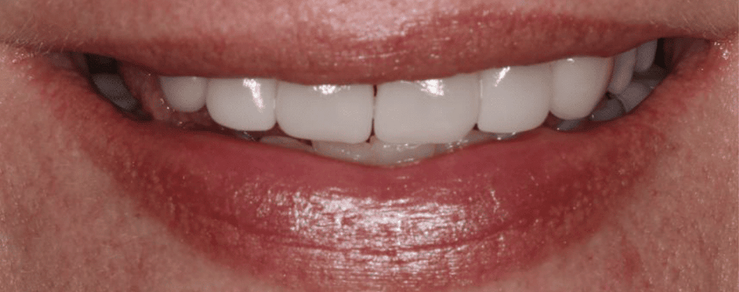 Patient with white teeth after receiving teeth whitening in Mechanicsville.