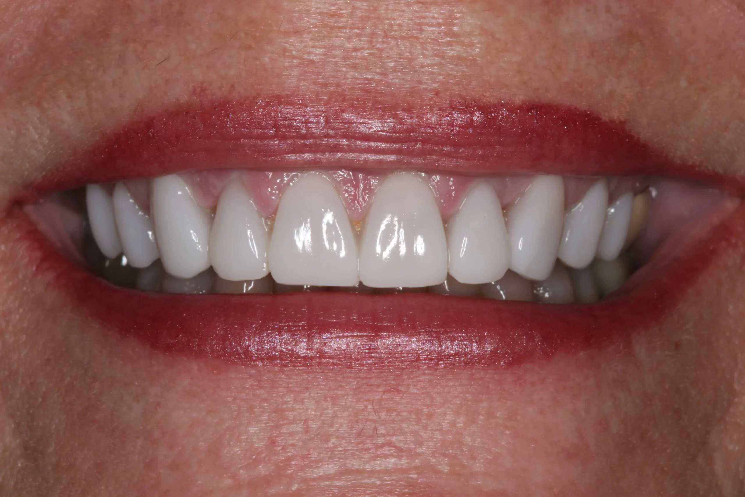 Patient after receiving porcelain teeth veneers