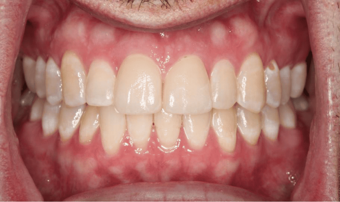 Patient from Waldorf after receiving cosmetic bonding from St. Mary's Dental.