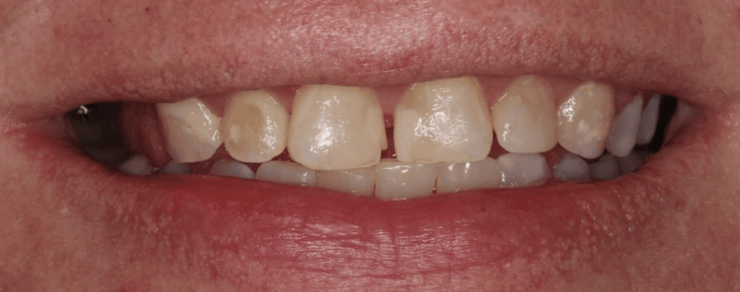 Patient from Waldorf with discolored teeth before undergoing professional teeth whitening.