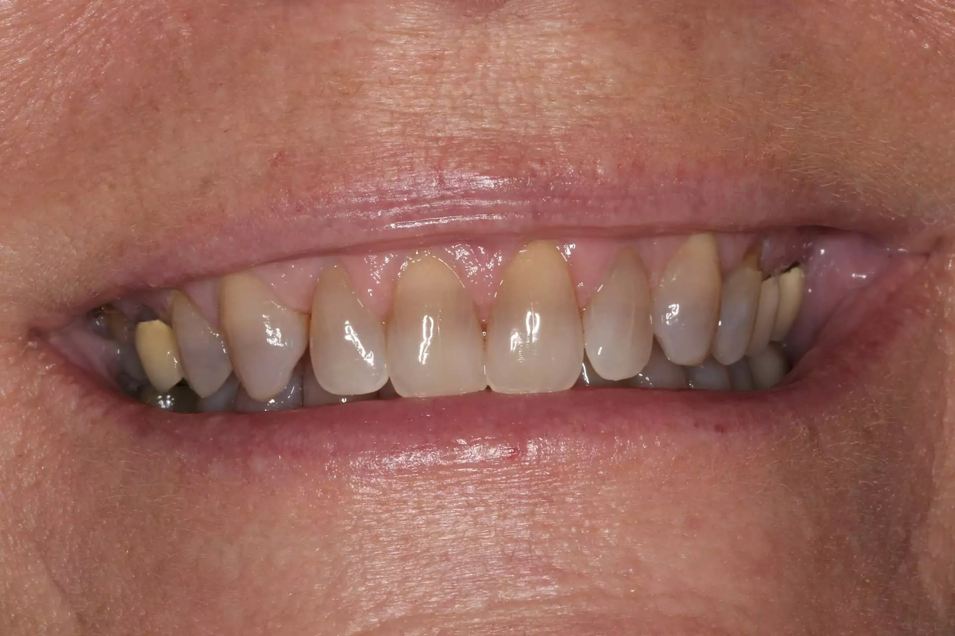 Patient from Leonardtown before receiving teeth veneers