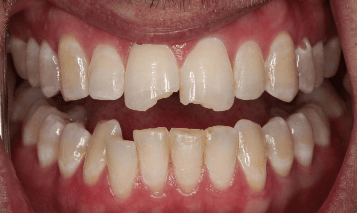 Patient with broken and cracked teeth before receiving dental bonding treatment in Mechanicsville, MD.