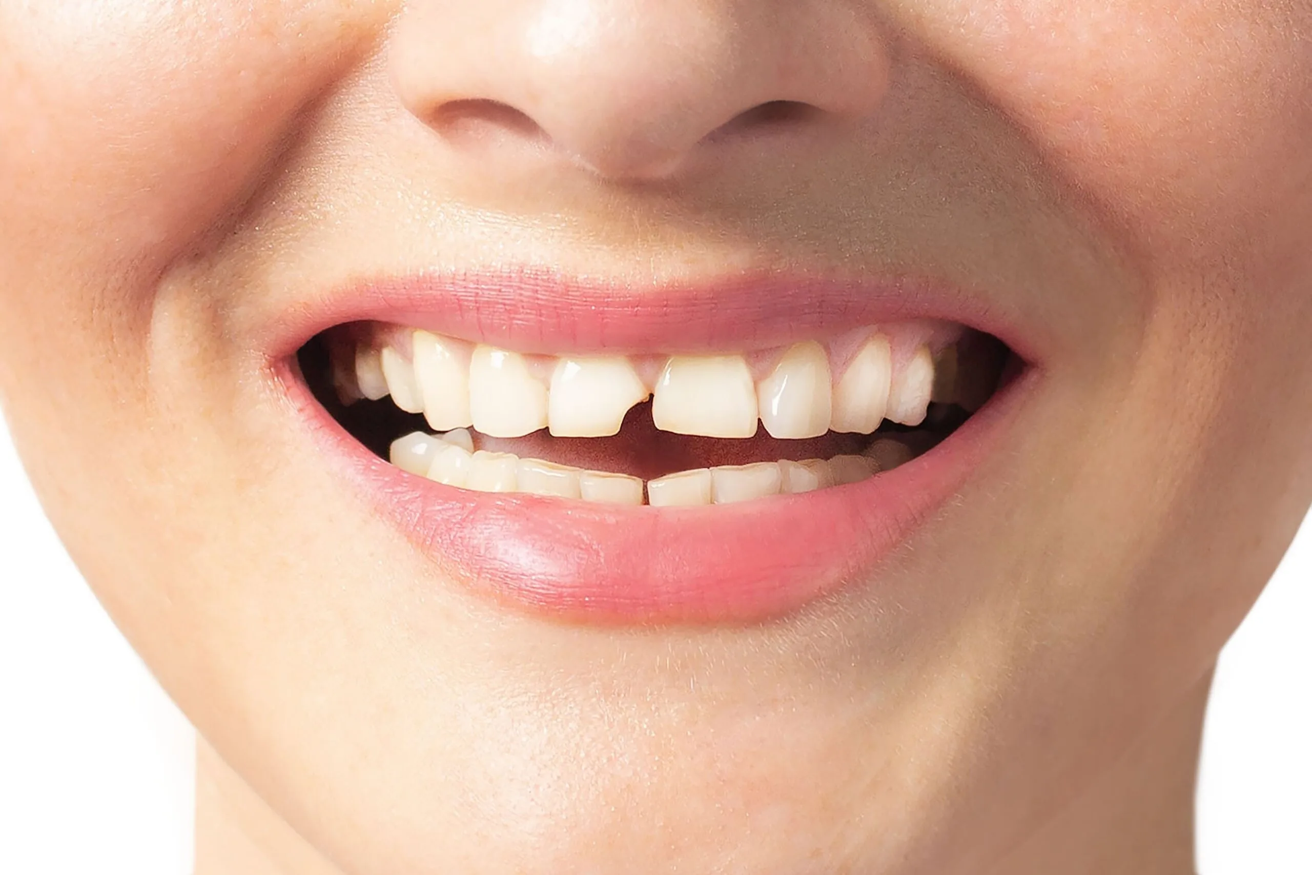 closeup of a woman with a chipped front tooth