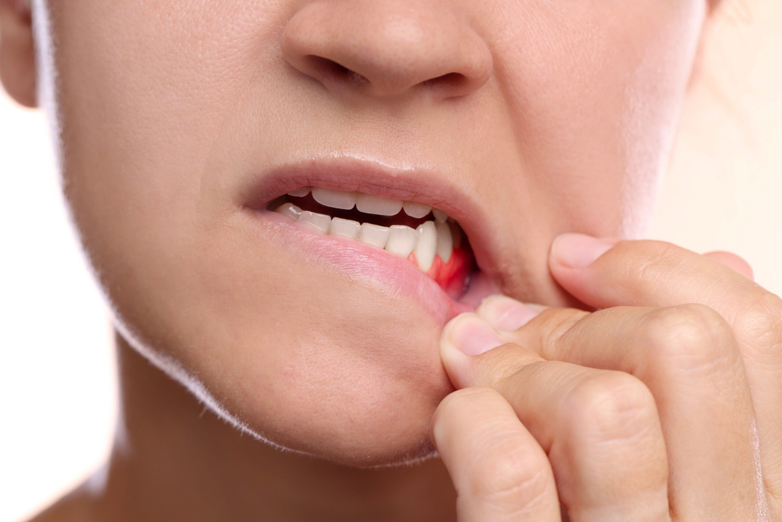 closeup of a woman pulling down her lip showing inflamed gum, early sign of gum disease